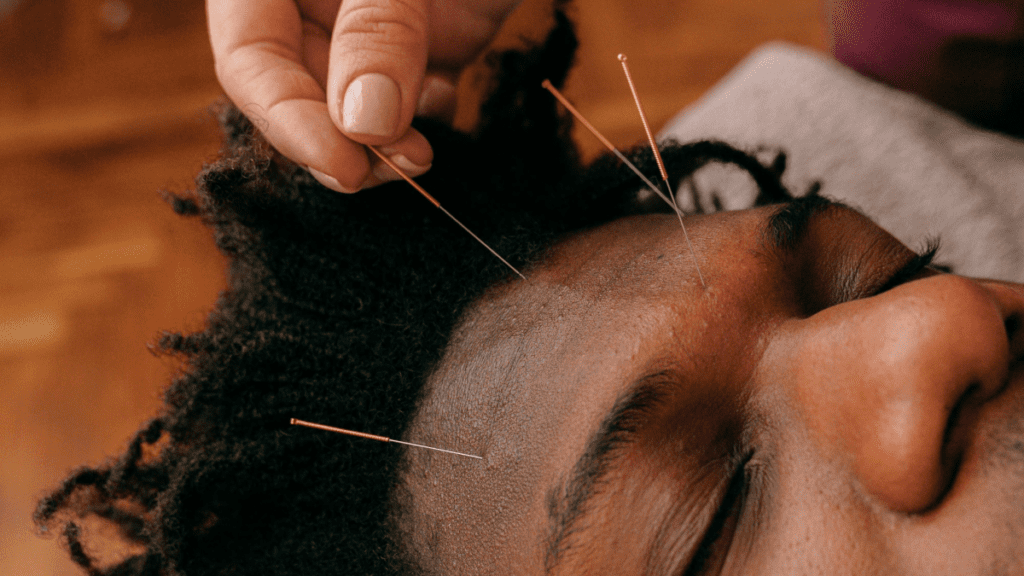 Acupuncture du visage_1 | Treatwell