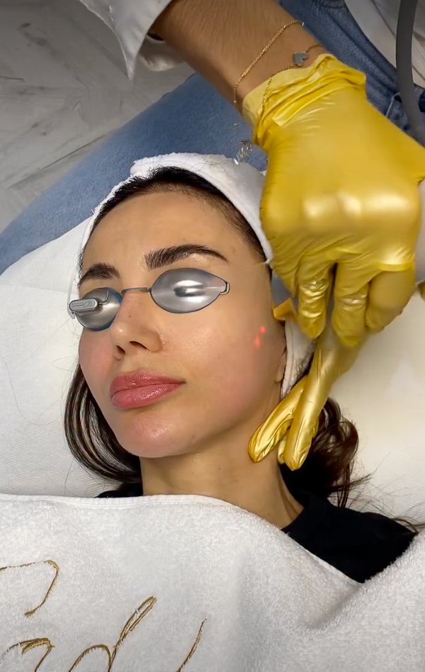 Fotoringiovanimento (IPL), IG @sadaf_jaffari | Treatwell